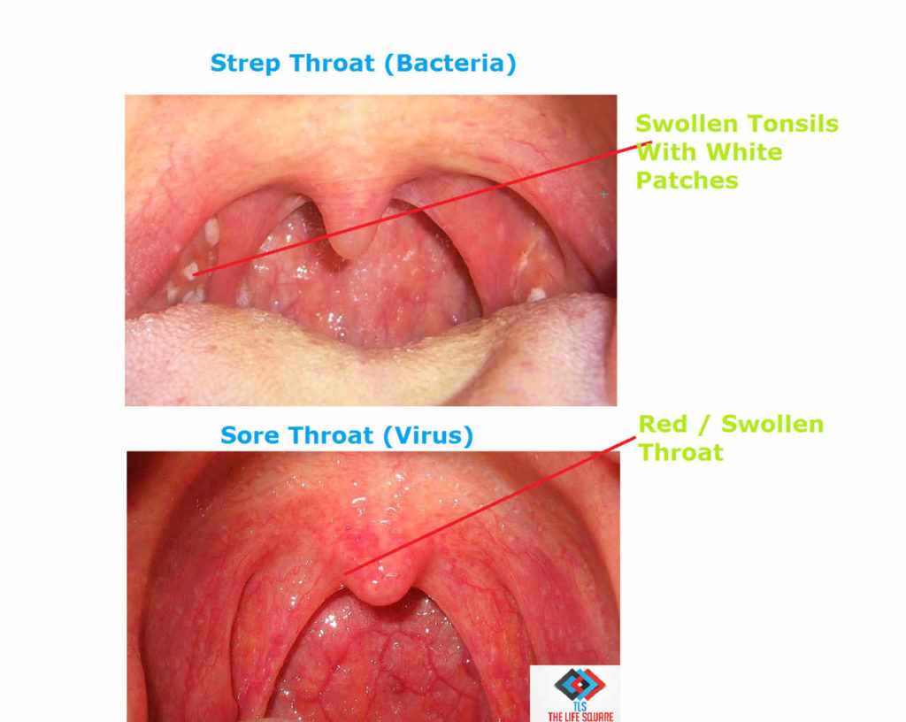 Health Care SHTF Part 1 Strep Throat The Medic Shack